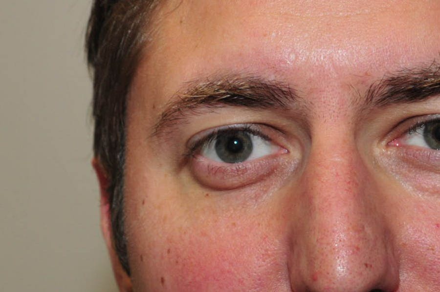 Reconstructive Eye Before & After Gallery - Patient 175252 - Image 2