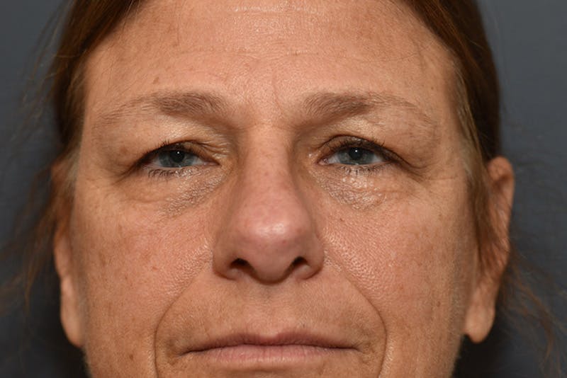Ptosis Repair Before & After Gallery - Patient 110547 - Image 2