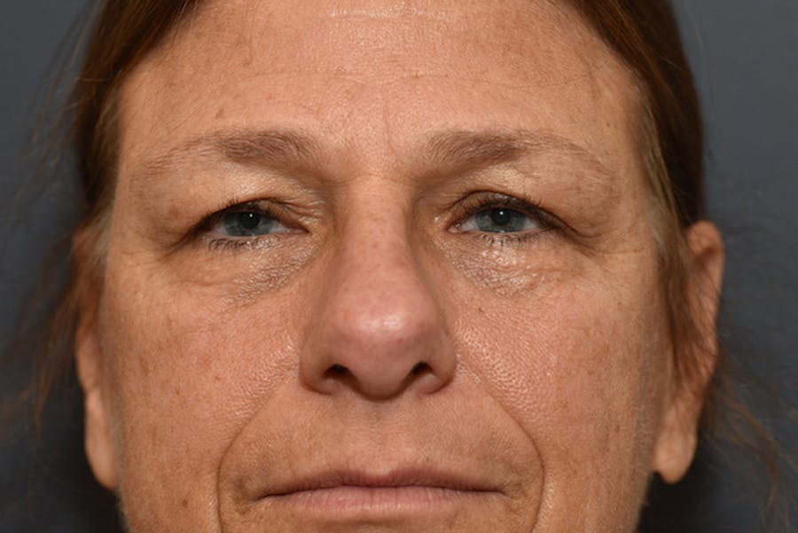 Ptosis Repair Before & After Gallery - Patient 110547 - Image 2
