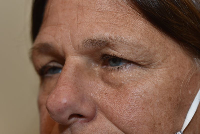 Ptosis Repair Before & After Gallery - Patient 110547 - Image 3