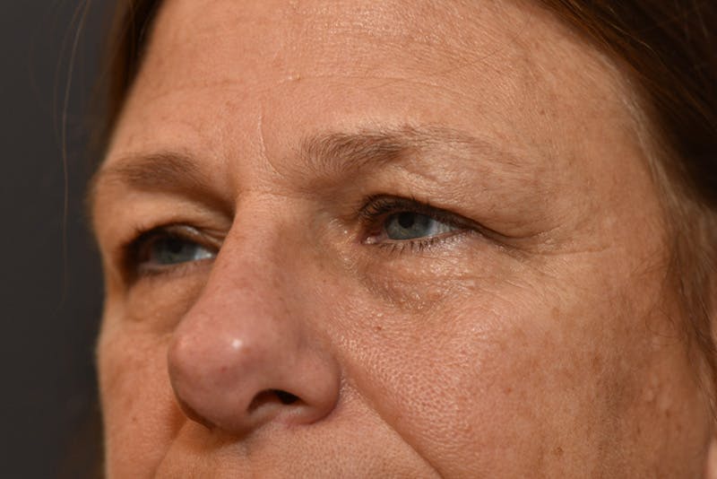 Ptosis Repair Before & After Gallery - Patient 110547 - Image 4