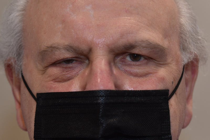 Ptosis Repair Before & After Gallery - Patient 407471 - Image 1