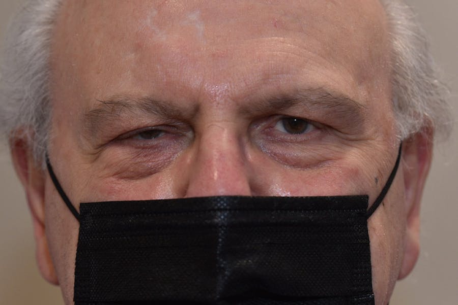 Ptosis Repair Before & After Gallery - Patient 407471 - Image 1