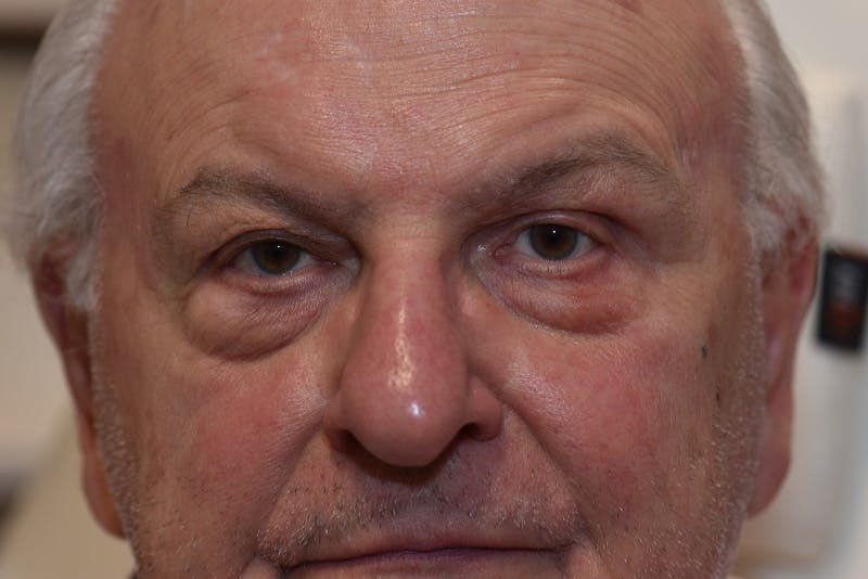 Ptosis Repair Before & After Gallery - Patient 407471 - Image 2