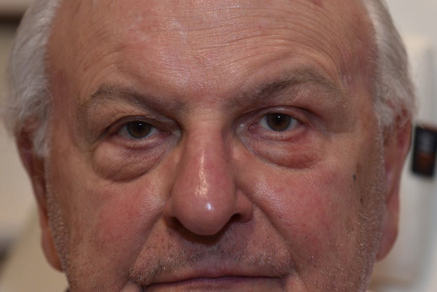 Ptosis Repair Before & After Gallery - Patient 407471 - Image 2