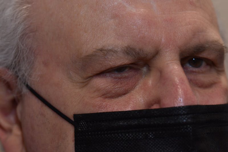 Ptosis Repair Before & After Gallery - Patient 407471 - Image 3