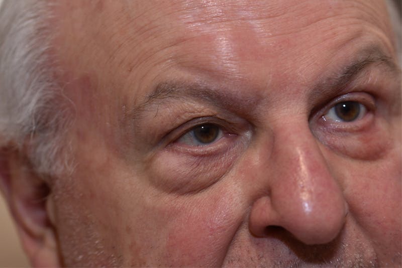 Ptosis Repair Before & After Gallery - Patient 407471 - Image 4