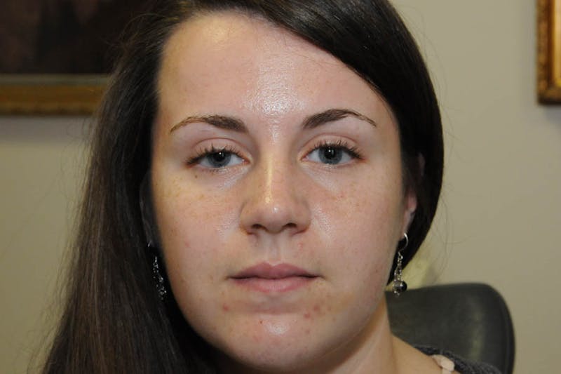 Ptosis Repair Before & After Gallery - Patient 246478 - Image 1