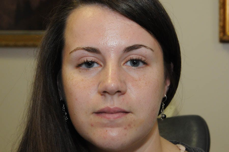 Ptosis Repair Before & After Gallery - Patient 246478 - Image 1