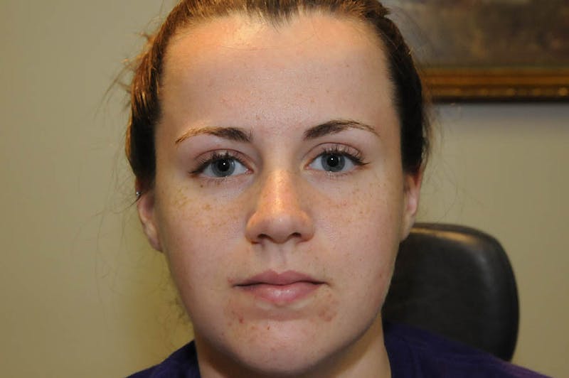 Ptosis Repair Before & After Gallery - Patient 246478 - Image 2