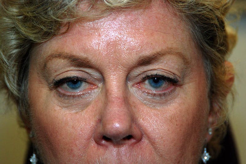 Ptosis Repair Before & After Gallery - Patient 253491 - Image 1