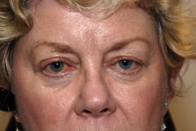 Ptosis Repair Before & After Gallery - Patient 253491 - Image 2