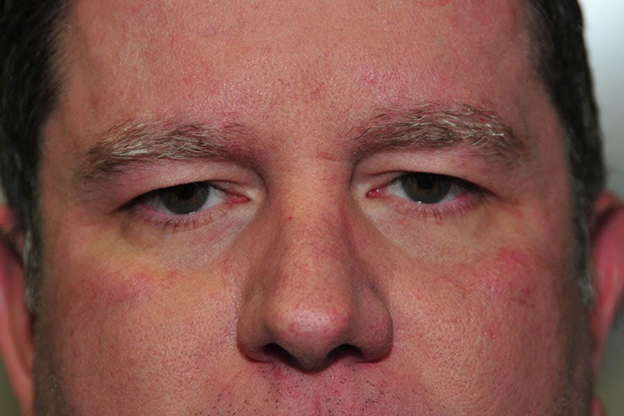 Ptosis Repair Before & After Gallery - Patient 416131 - Image 1
