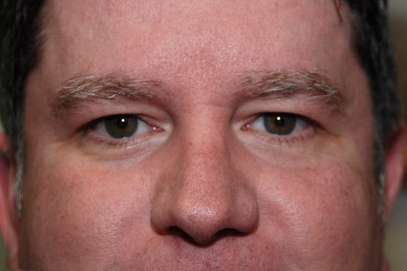 Ptosis Repair Before & After Gallery - Patient 416131 - Image 2