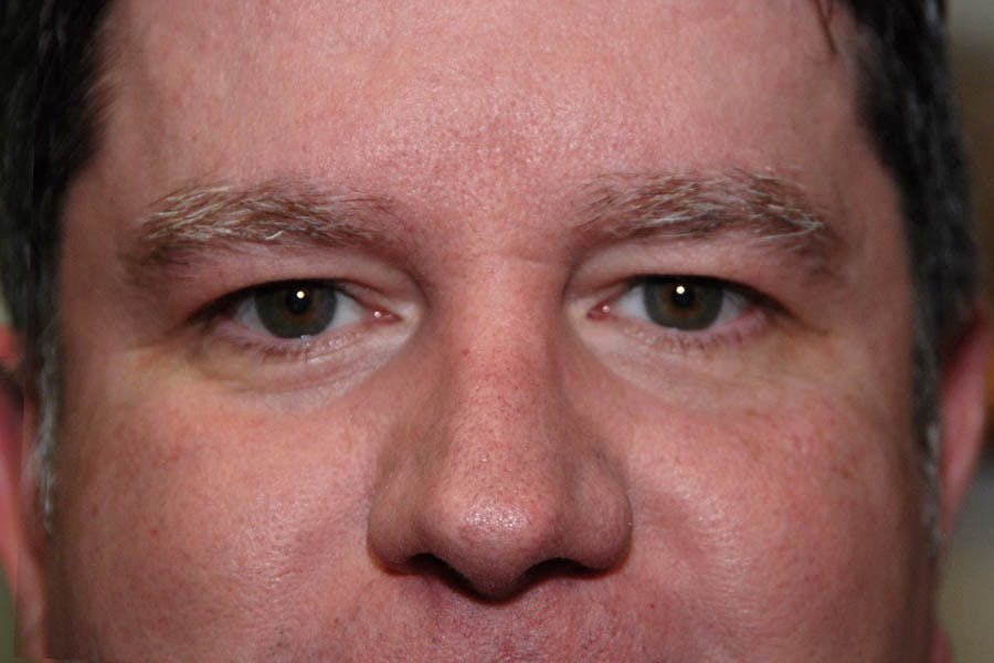 Ptosis Repair Before & After Gallery - Patient 416131 - Image 2