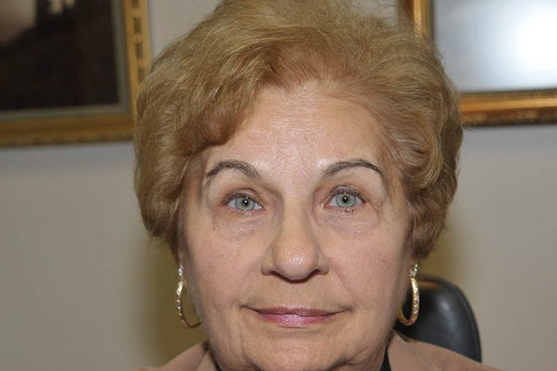 Ptosis Repair Before & After Gallery - Patient 375380 - Image 2