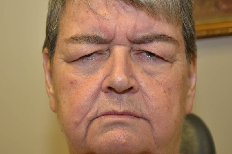 Ptosis Repair Before & After Gallery - Patient 234470 - Image 1