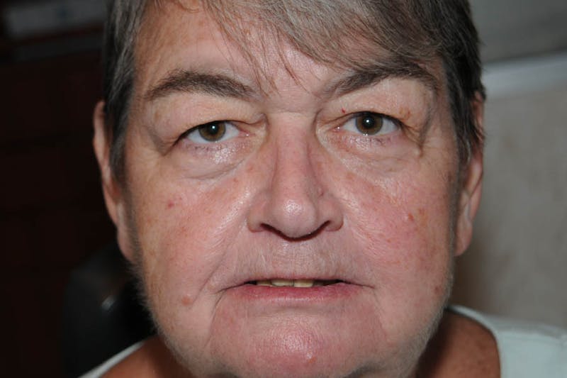 Ptosis Repair Before & After Gallery - Patient 234470 - Image 2