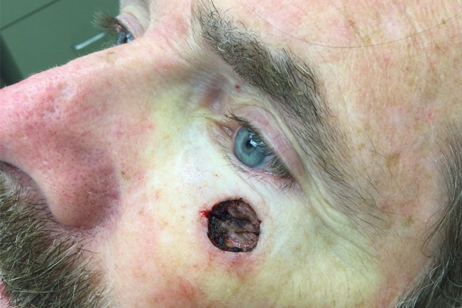 Mohs Closure Before & After Gallery - Patient 103224 - Image 1