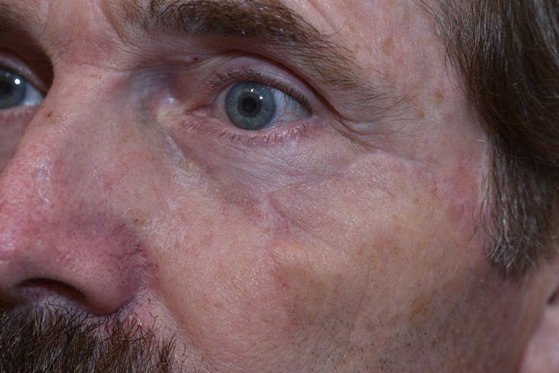 Mohs Closure Before & After Gallery - Patient 103224 - Image 2