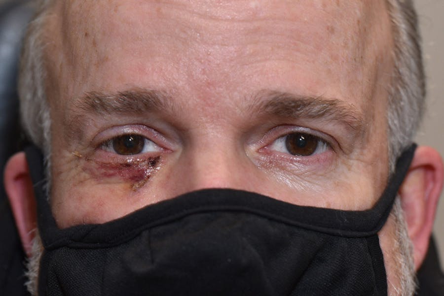 Mohs Closure Before & After Gallery - Patient 724684 - Image 1