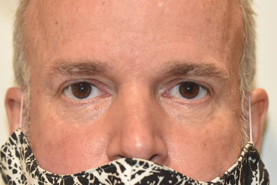 Mohs Closure Before & After Gallery - Patient 724684 - Image 2
