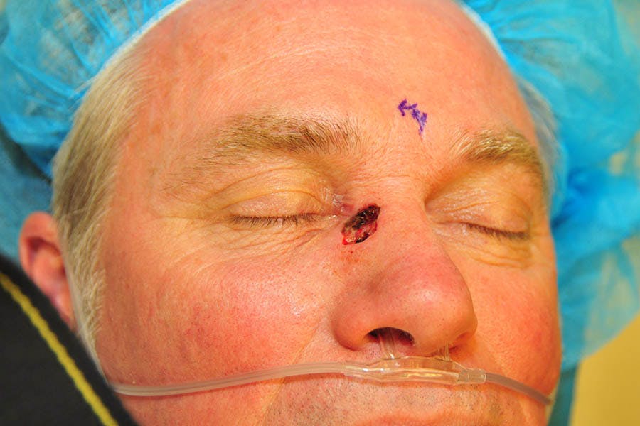 Mohs Closure Before & After Gallery - Patient 937626 - Image 1