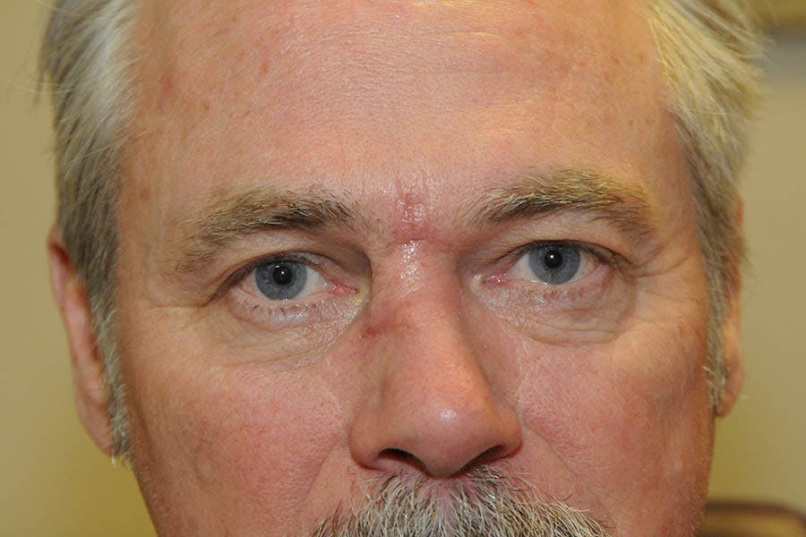 Mohs Closure Before & After Gallery - Patient 937626 - Image 2