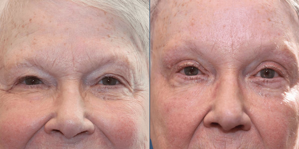 Endoscopic Brow Lift Before & After Gallery - Patient 428218 - Image 1