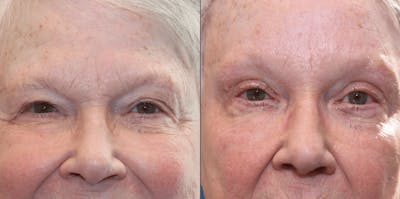 Endoscopic Brow Lift with Upper Blepharoplasty Before & After Gallery - Patient 100356 - Image 1