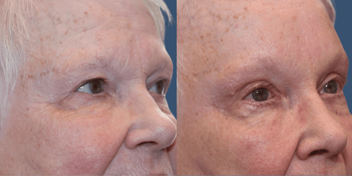 Endoscopic Brow Lift Before & After Gallery - Patient 428218 - Image 2