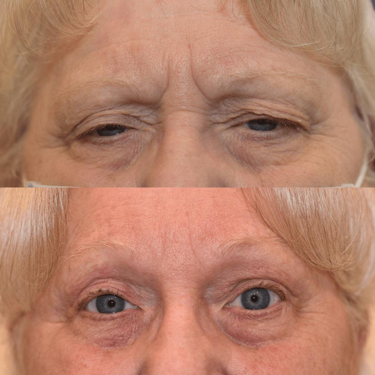 Endoscopic Brow Lift Before & After Gallery - Patient 122545 - Image 2