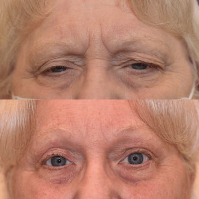 Endoscopic Brow Lift with Upper Blepharoplasty Before & After Gallery - Patient 221913 - Image 1