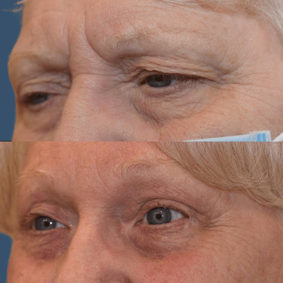 Endoscopic Brow Lift Before & After Gallery - Patient 122545 - Image 1
