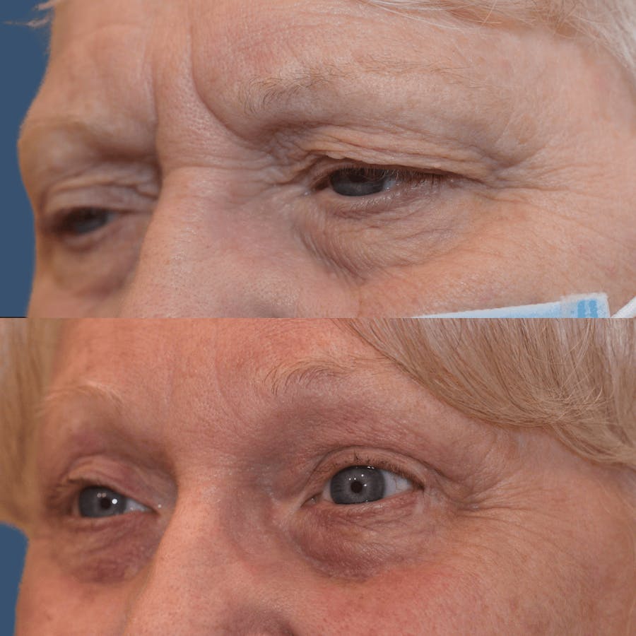 Endoscopic Brow Lift Before & After Gallery - Patient 122545 - Image 1