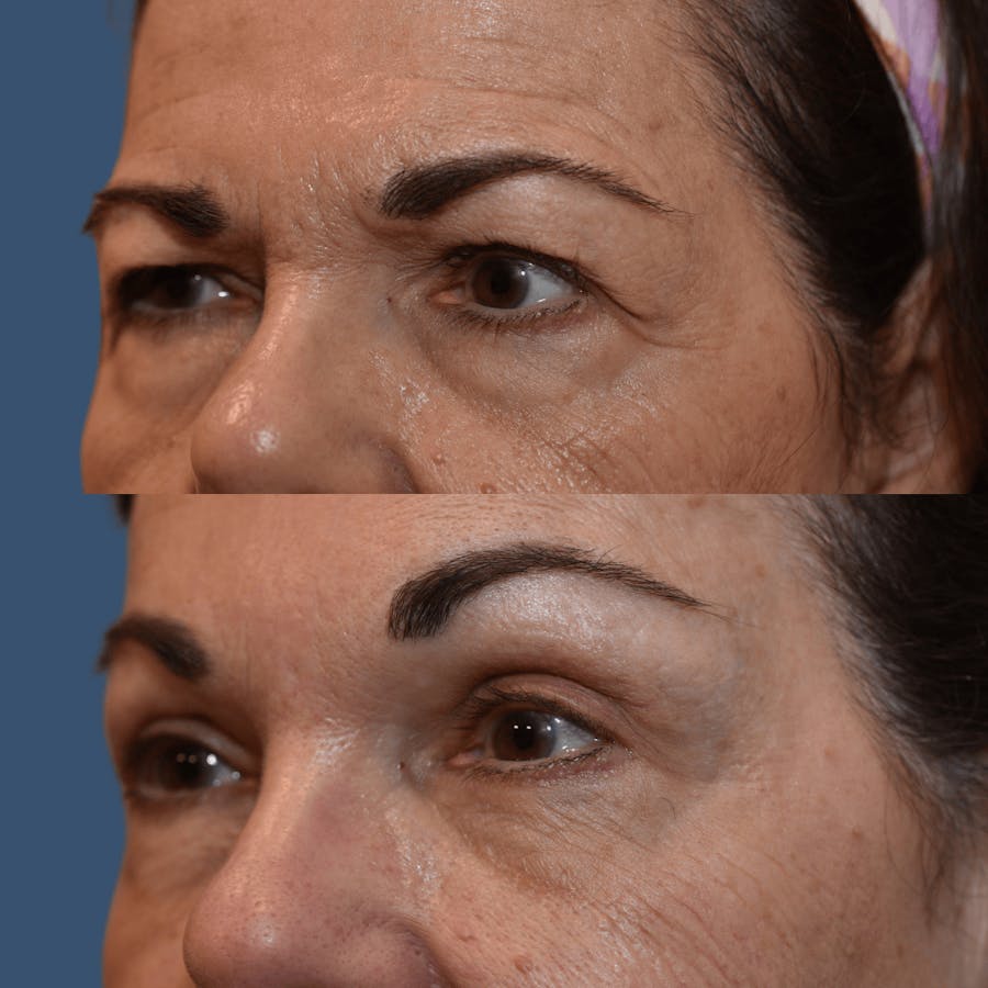 Endoscopic Brow Lift Before & After Gallery - Patient 559309 - Image 1