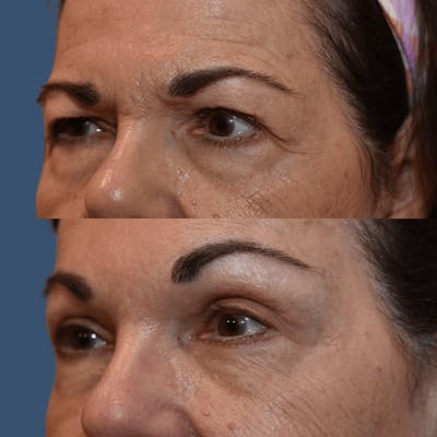 Endoscopic Brow Lift with Upper Blepharoplasty Before & After Gallery - Patient 371331 - Image 1