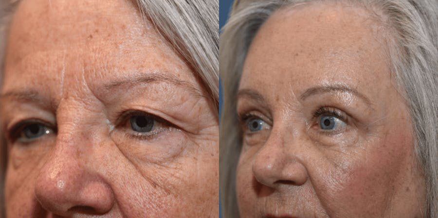 Endoscopic Brow Lift Before & After Gallery - Patient 144446 - Image 1