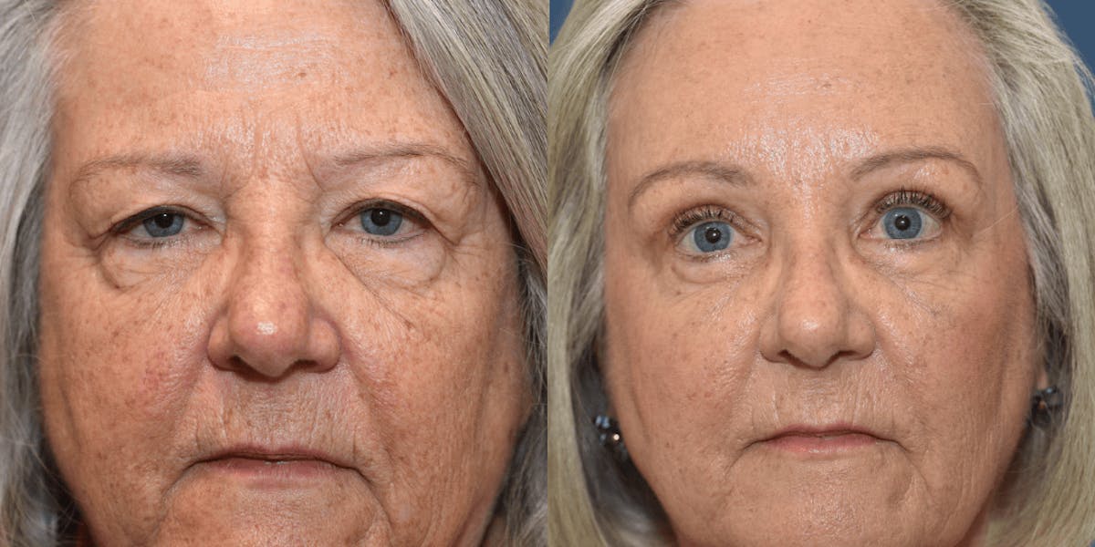 Endoscopic Brow Lift Before & After Gallery - Patient 144446 - Image 2
