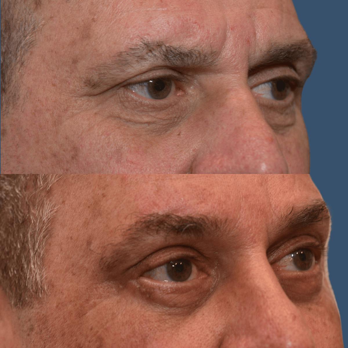 Endoscopic Brow Lift Before & After Gallery - Patient 250581 - Image 1