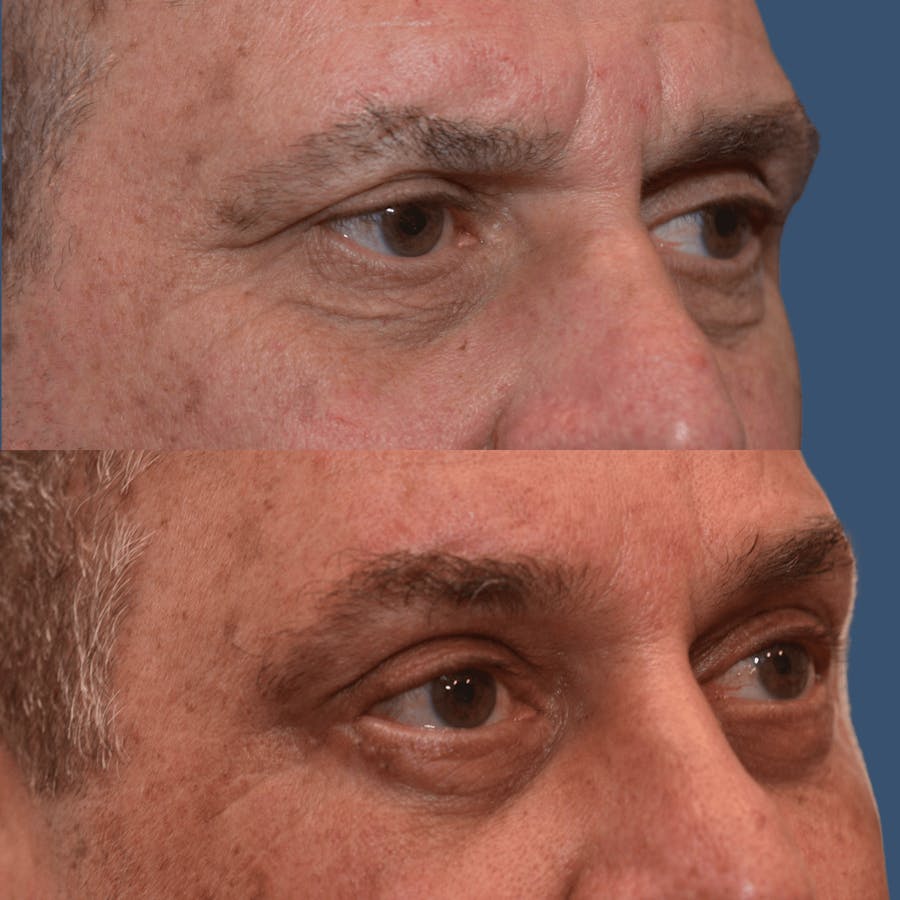 Endoscopic Brow Lift Before & After Gallery - Patient 250581 - Image 1