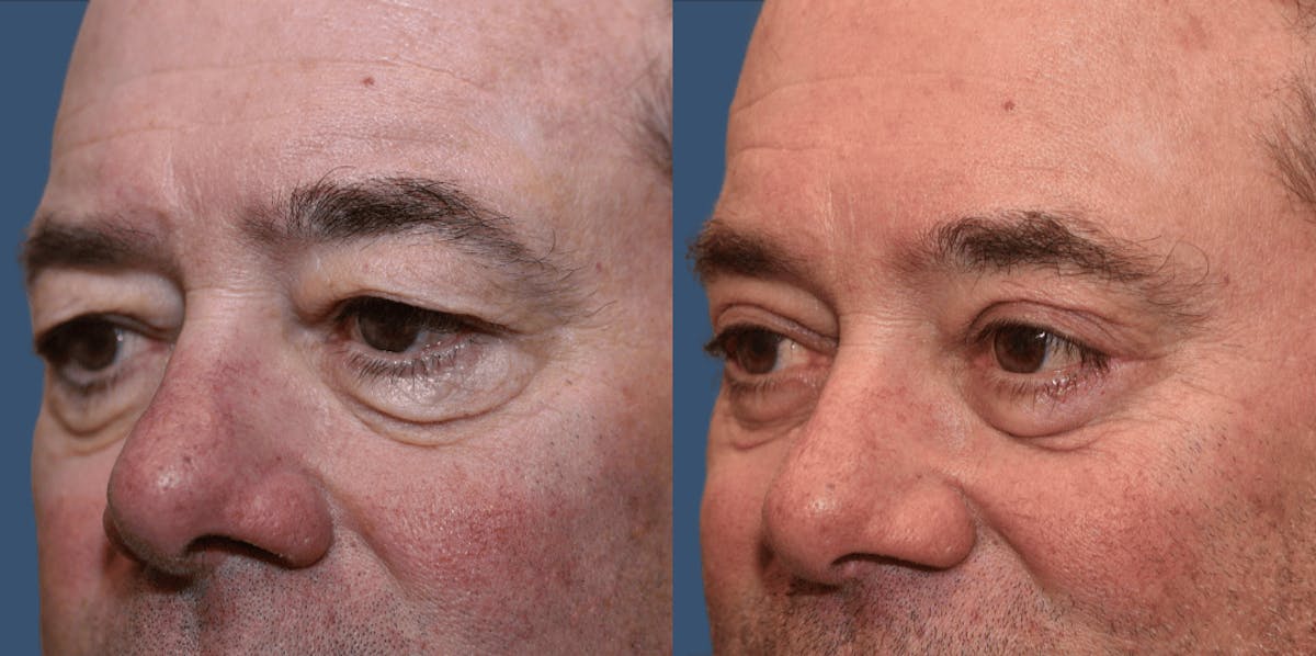 Endoscopic Brow Lift Before & After Gallery - Patient 359074 - Image 1