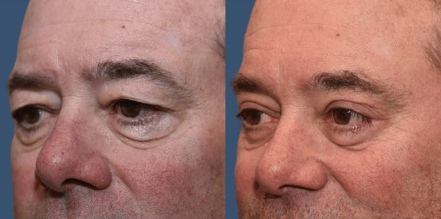 Endoscopic Brow Lift Before & After Gallery - Patient 359074 - Image 1