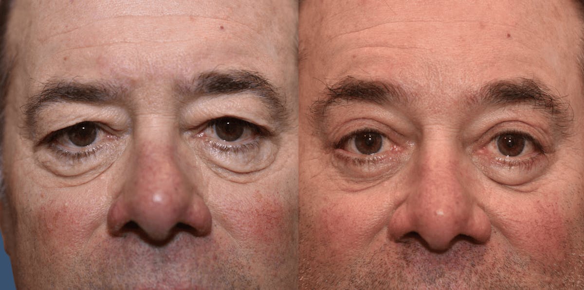 Endoscopic Brow Lift Before & After Gallery - Patient 359074 - Image 2