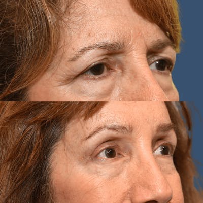 Endoscopic Brow Lift with Upper Blepharoplasty Before & After Gallery - Patient 138931 - Image 1