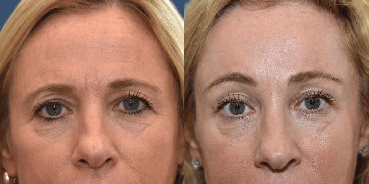Endoscopic Brow Lift Before & After Gallery - Patient 326218 - Image 1