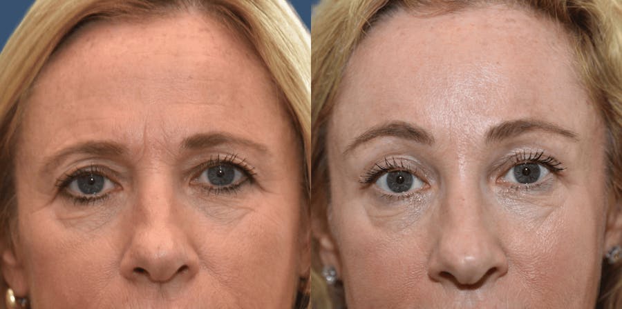 Endoscopic Brow Lift Before & After Gallery - Patient 326218 - Image 1