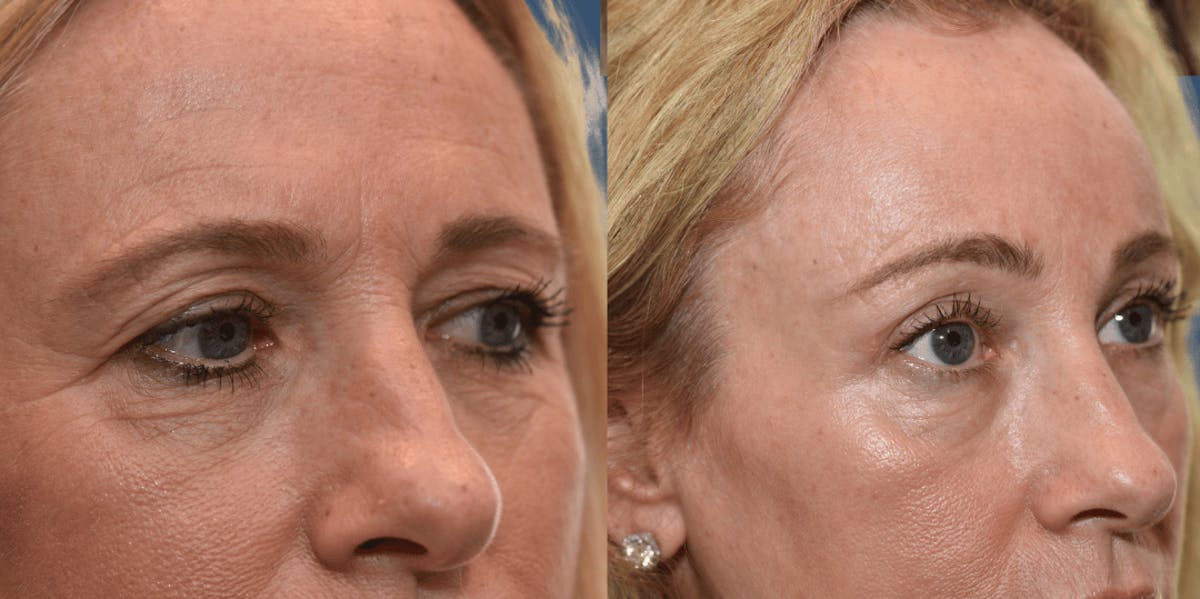 Endoscopic Brow Lift Before & After Gallery - Patient 326218 - Image 2