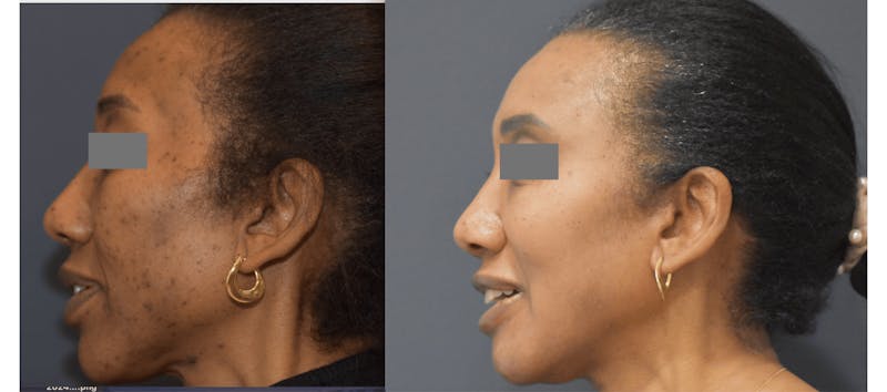Chemical Peels Before & After Gallery - Patient 363513 - Image 3