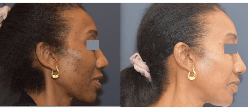 Chemical Peels Before & After Gallery - Patient 363513 - Image 2